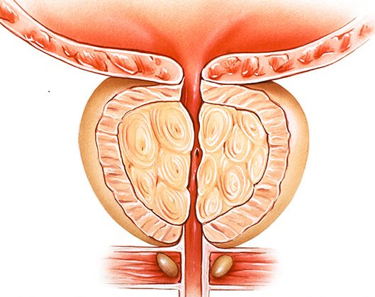 İyi huylu prostat büyümesini gösteren anatomik çizim