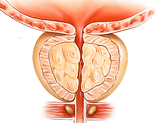 İYİ HUYLU PROSTAT BÜYÜMESI (BPH) iyi-huylu-prostat-buyumesi--bph-