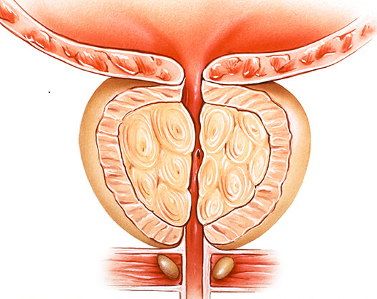 iyi-huylu-prostat-buyumesi--bph-