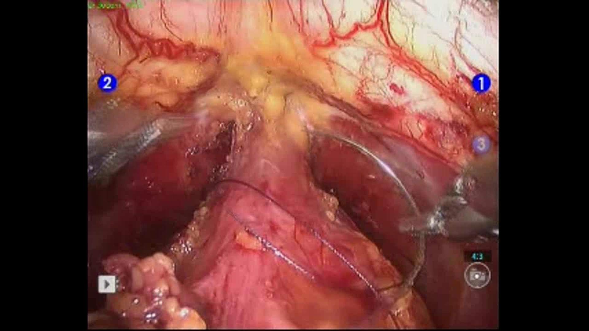 prostat-hastaliklari---erkeklerde-onemli-bir-saglik-sorunu