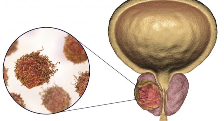 prostat-kanseri